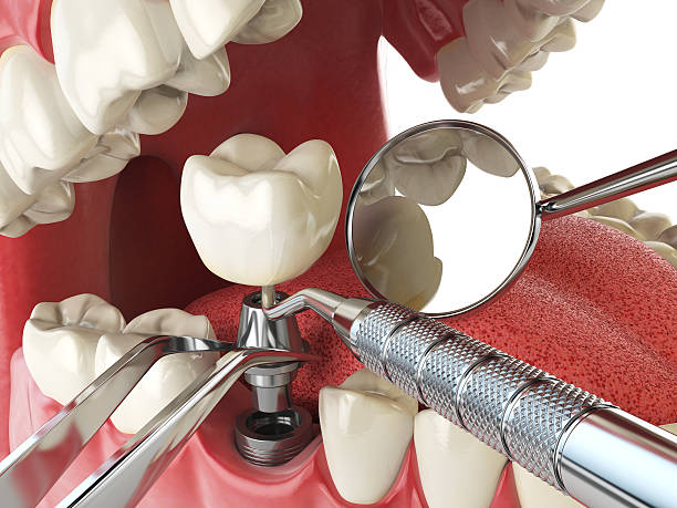Best Emergency Root Canal Treatment in Spring Valley, CA